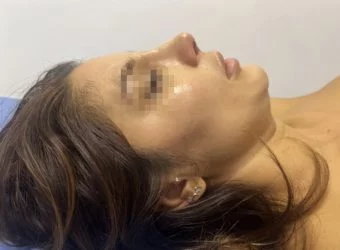 cirugia estetica de rinoplastia