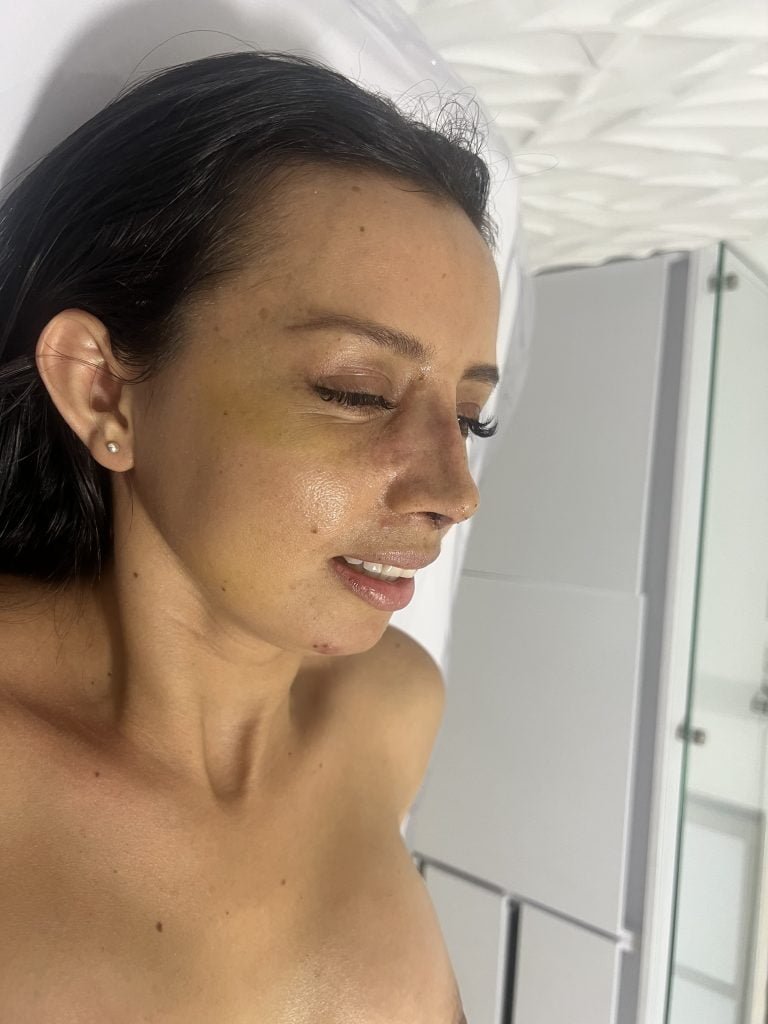 recuperación de rinoplastia