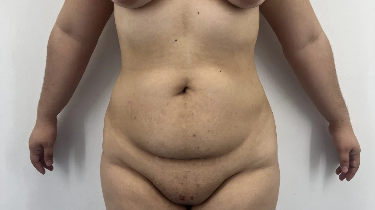 abdominoplastia cirugia