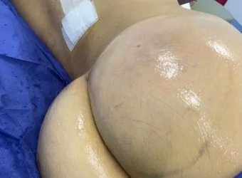 LIPO INYECCION GLUTEA